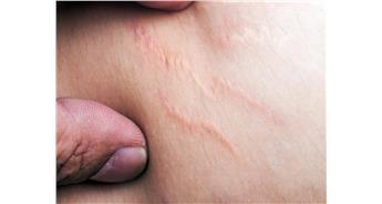 اسکار چگونه تشکیل میشود؟انواع اسکار