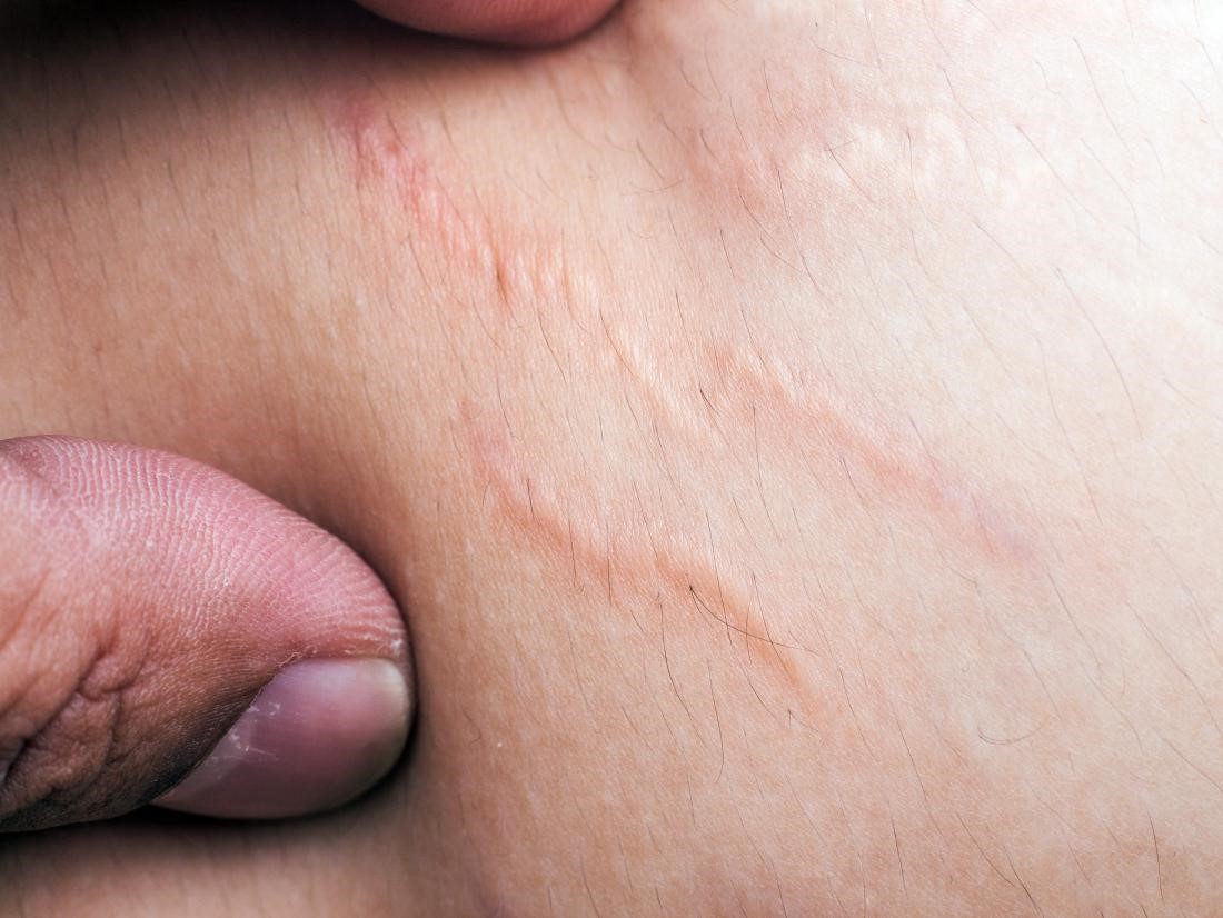 اسکار چگونه تشکیل می‌شود؟انواع اسکار