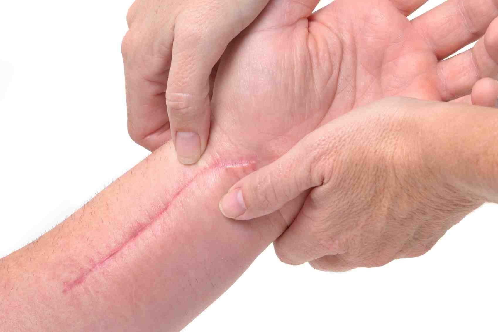 5 روش‌های مختلف برای درمان اسکار